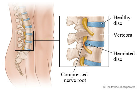 What is a Pinched Nerve in Lower Back?