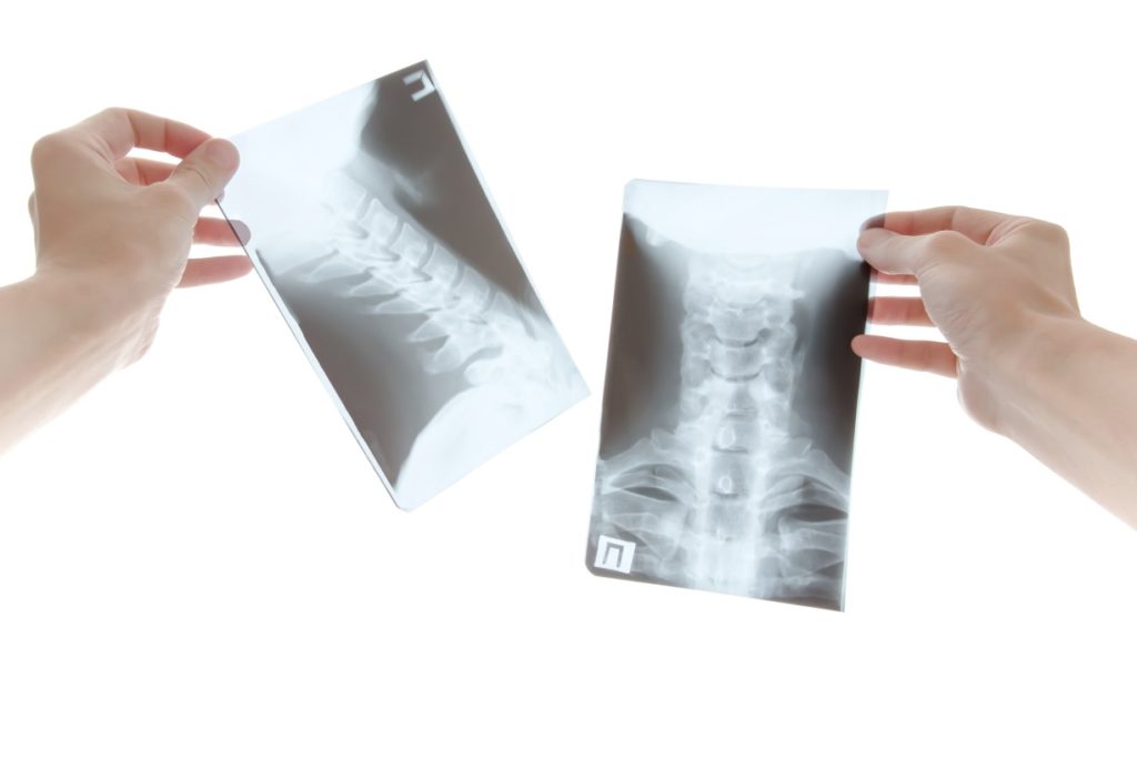 Affordable On-Site X-Rays in Denver | Reinhardt Chiropractic