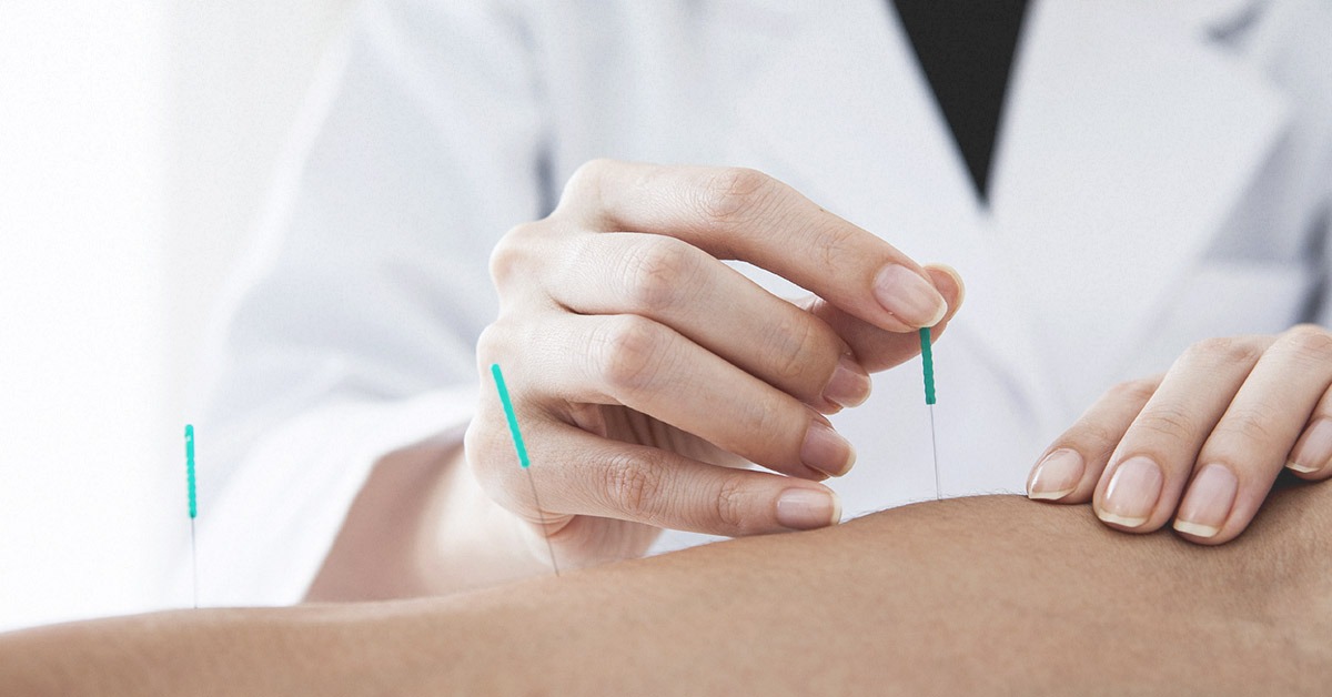 A doctor giving a patient dry needling therapy.